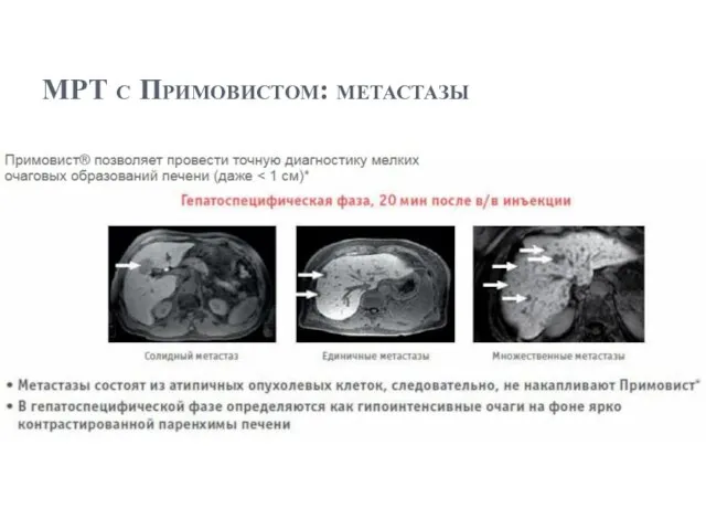 МРТ с Примовистом: метастазы