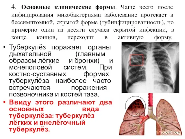 4. Основные клинические формы. Чаще всего после инфицирования микобактериями заболевание