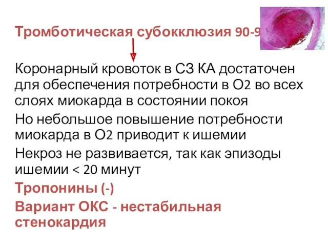 Тромботическая субокклюзия 90-95% Коронарный кровоток в СЗ КА достаточен для