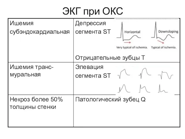 ЭКГ при ОКС