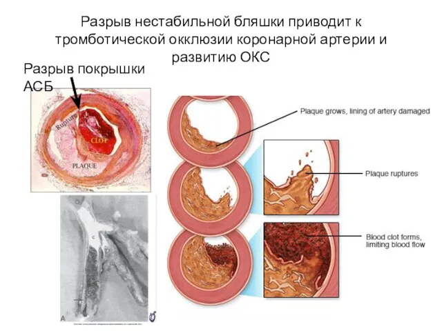 Разрыв нестабильной бляшки приводит к тромботической окклюзии коронарной артерии и развитию ОКС Разрыв покрышки АСБ