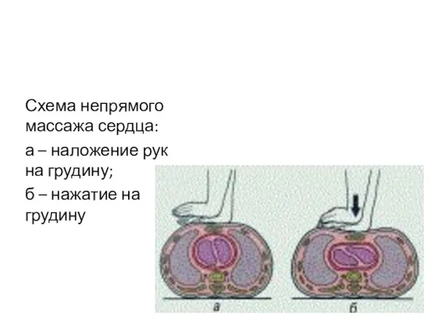Схема непрямого массажа сердца: а – наложение рук на грудину; б – нажатие на грудину