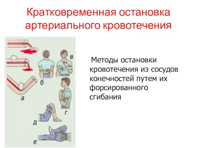 Кратковременная остановка артериального кровотечения Методы остановки кровотечения из сосудов конечностей путем их форсированного сгибания