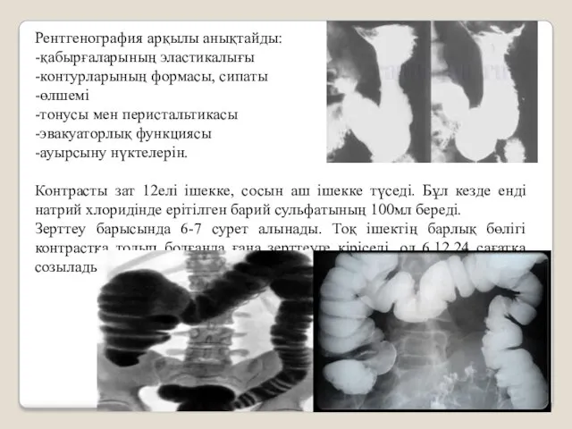 Рентгенография арқылы анықтайды: -қабырғаларының эластикалығы -контурларының формасы, сипаты -өлшемі -тонусы мен перистальтикасы -эвакуаторлық