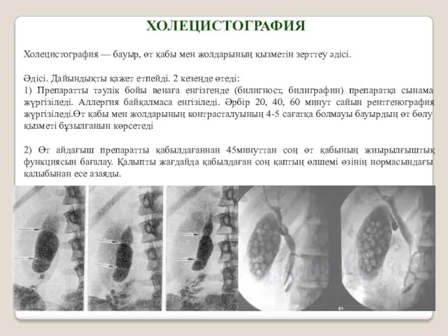 Холецистография — бауыр, өт қабы мен жолдарының қызметін зерттеу әдісі. Әдісі. Дайындықты қажет