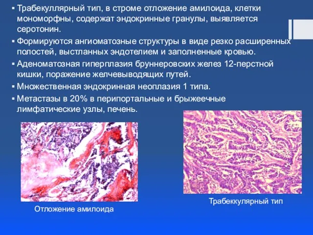 Трабекуллярный тип, в строме отложение амилоида, клетки мономорфны, содержат эндокринные гранулы, выявляется серотонин.