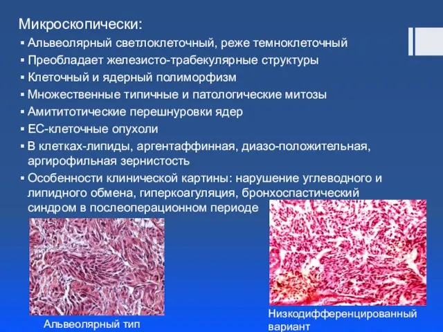 Микроскопически: Альвеолярный светлоклеточный, реже темноклеточный Преобладает железисто-трабекулярные структуры Клеточный и