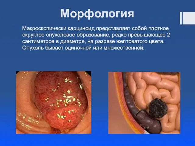 Морфология Макроскопически карциноид представляет собой плотное округлое опухолевое образование, редко