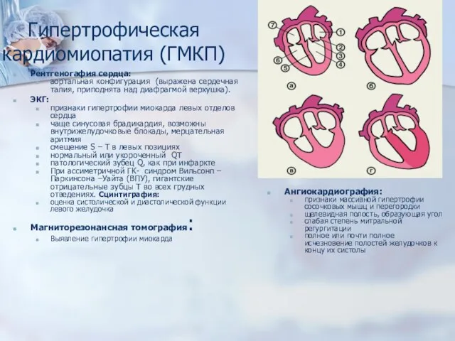 Гипертрофическая кардиомиопатия (ГМКП) Рентгеногафия сердца: аортальная конфигурация (выражена сердечная талия, приподнята над диафрагмой