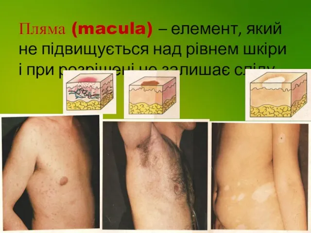 Пляма (macula) – елемент, який не підвищується над рівнем шкіри і при розрішені не залишає сліду.