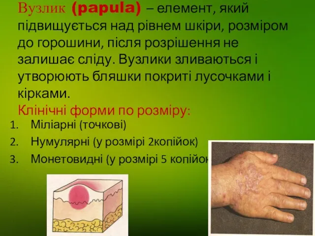 Вузлик (papula) – елемент, який підвищується над рівнем шкіри, розміром до горошини, після