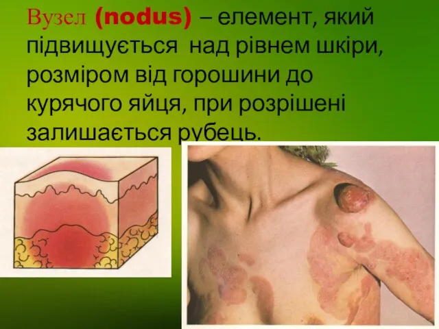 Вузел (nodus) – елемент, який підвищується над рівнем шкіри, розміром від горошини до