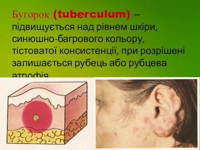 Бугорок (tuberculum) – підвищується над рівнем шкіри, синюшно-багрового кольору, тістоватої консистенції, при розрішені