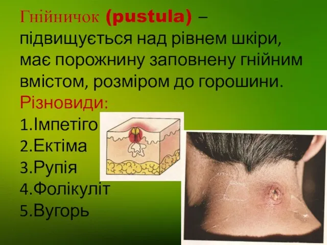 Гнійничок (pustula) – підвищується над рівнем шкіри, має порожнину заповнену гнійним вмістом, розміром