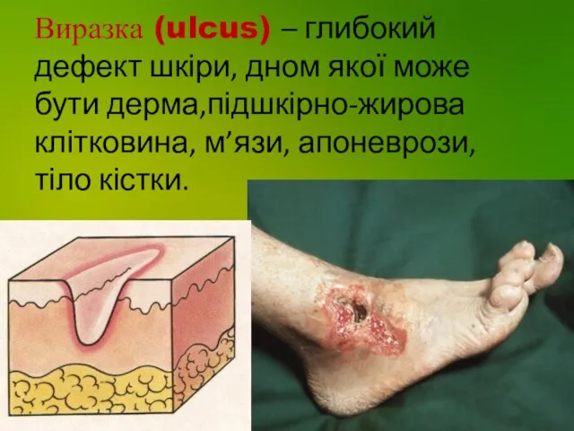 Виразка (ulcus) – глибокий дефект шкіри, дном якої може бути дерма,підшкірно-жирова клітковина, м’язи, апоневрози, тіло кістки.