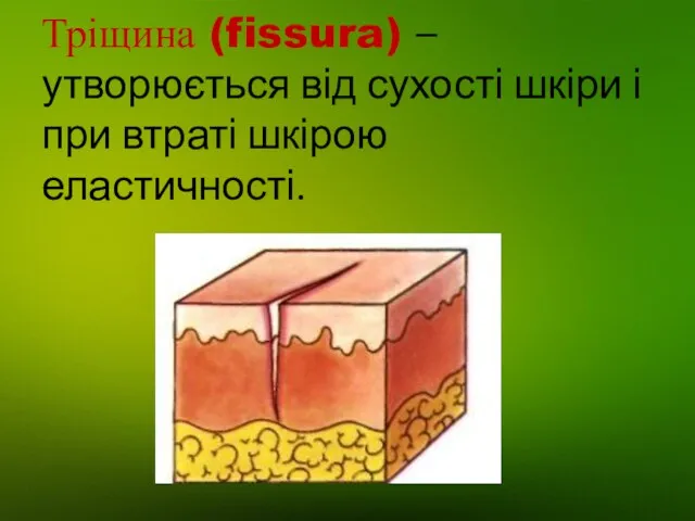 Тріщина (fissura) – утворюється від сухості шкіри і при втраті шкірою еластичності.