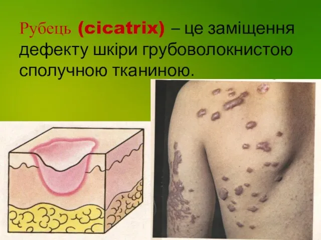 Рубець (cicatrix) – це заміщення дефекту шкіри грубоволокнистою сполучною тканиною.
