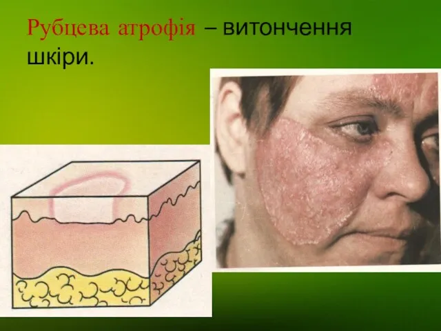 Рубцева атрофія – витончення шкіри.