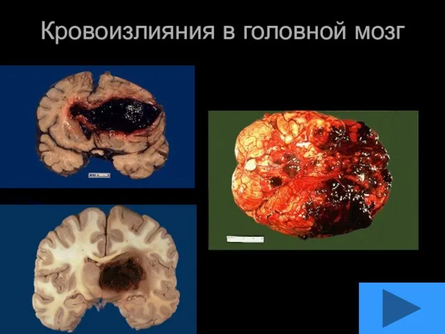Кровоизлияния в головной мозг
