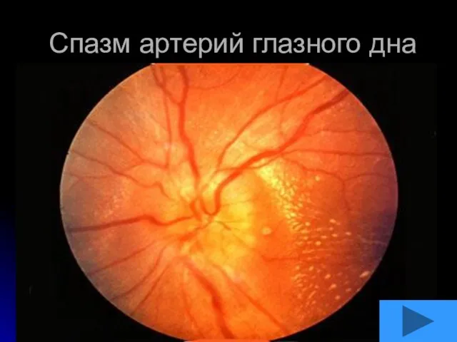 Спазм артерий глазного дна