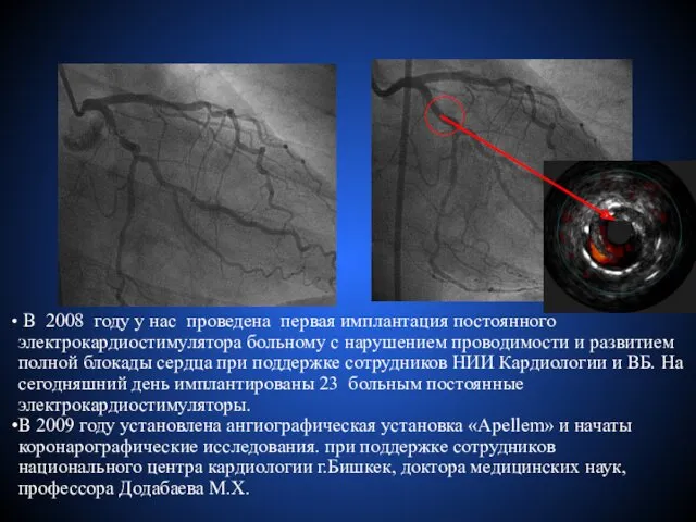 В 2008 году у нас проведена первая имплантация постоянного электрокардиостимулятора больному с нарушением