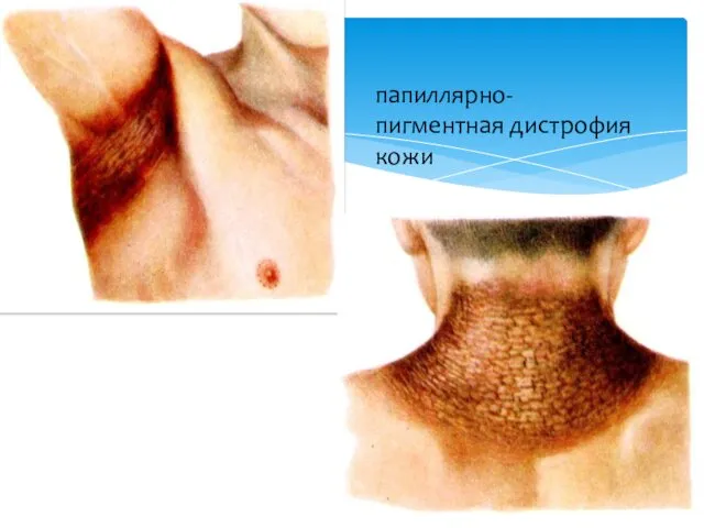 папиллярно-пигментная дистрофия кожи