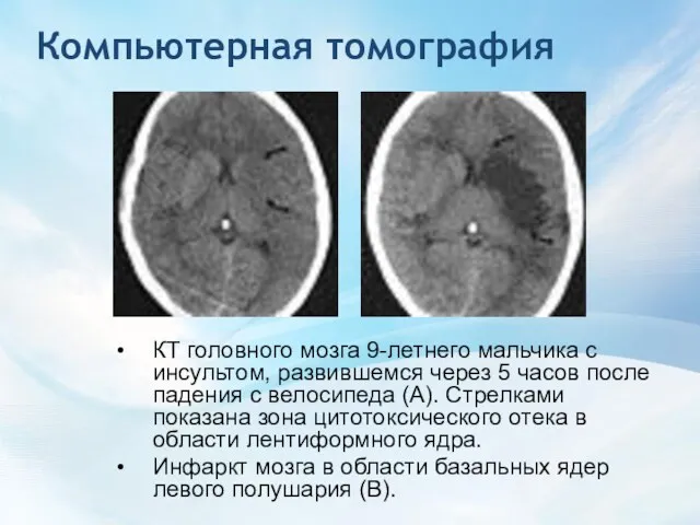 Компьютерная томография КТ головного мозга 9-летнего мальчика с инсультом, развившемся