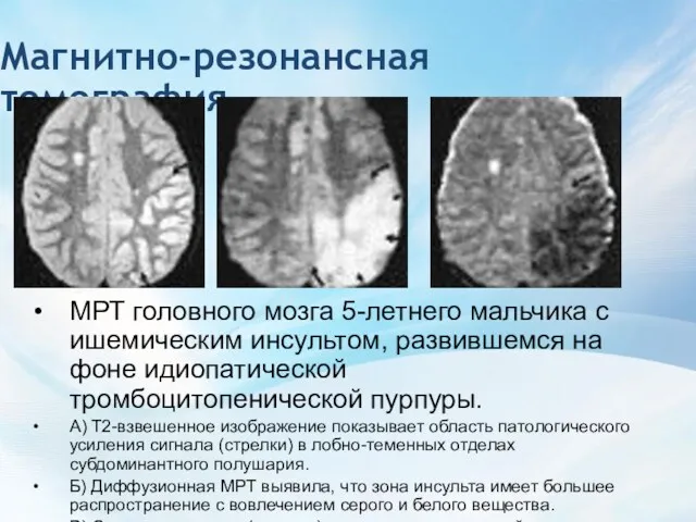 Магнитно-резонансная томография МРТ головного мозга 5-летнего мальчика с ишемическим инсультом,