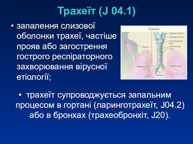 Трахеїт (J 04.1) запалення слизової оболонки трахеї, частіше прояв або