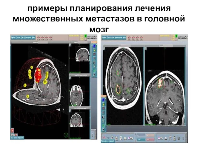 примеры планирования лечения множественных метастазов в головной мозг