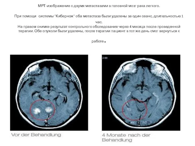 МРТ-изображение с двумя метастазами в головной мозг рака легкого. При помощи системы "Кибернож"