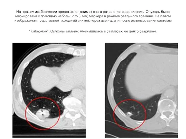 На правом изображении представлен снимок очага рака легкого до лечения. Опухоль была маркирована