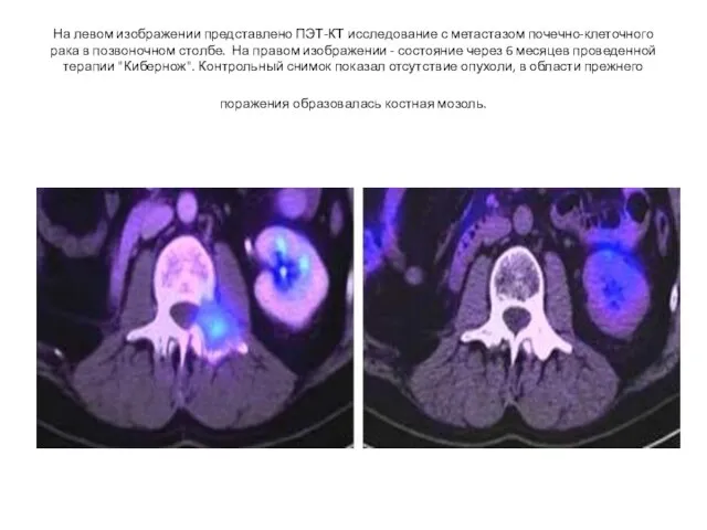 На левом изображении представлено ПЭТ-КТ исследование с метастазом почечно-клеточного рака в позвоночном столбе.