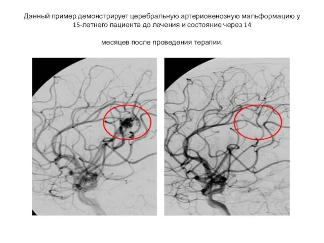 Данный пример демонстрирует церебральную артериовенозную мальформацию у 15-летнего пациента до лечения и состояние
