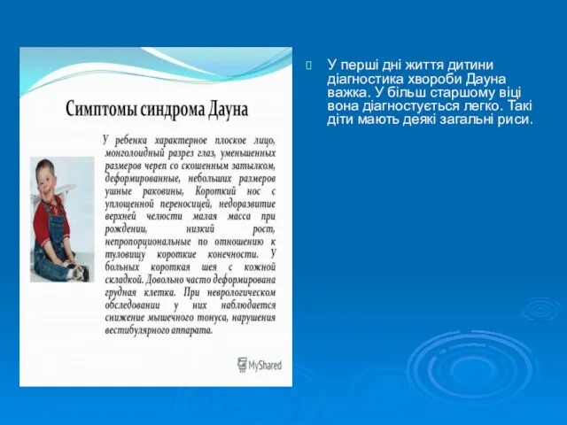 У перші дні життя дитини діагностика хвороби Дауна важка. У