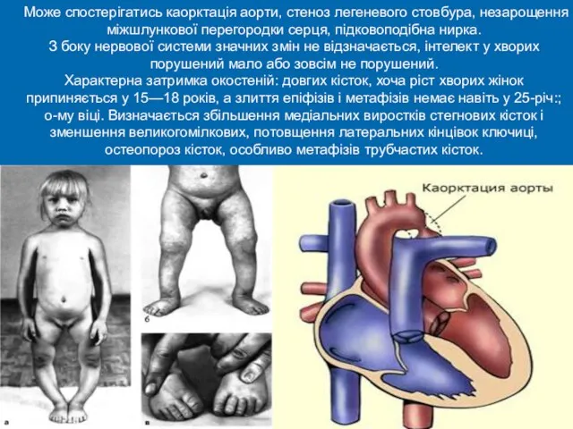 Може спостерігатись каорктація аорти, стеноз легеневого стовбура, незарощення міжшлункової перегородки