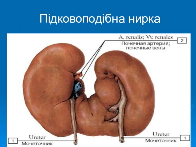 Підковоподібна нирка