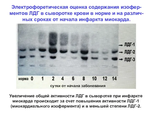 Электрофоретическая оценка содержания изофер-ментов ЛДГ в сыворотке крови в норме