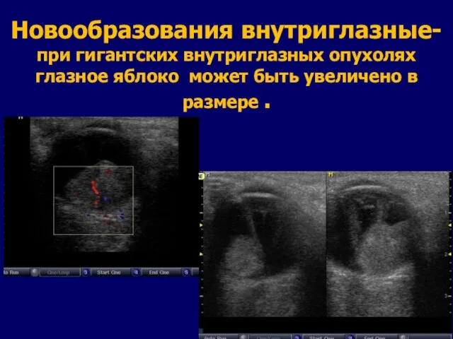 Новообразования внутриглазные- при гигантских внутриглазных опухолях глазное яблоко может быть увеличено в размере .