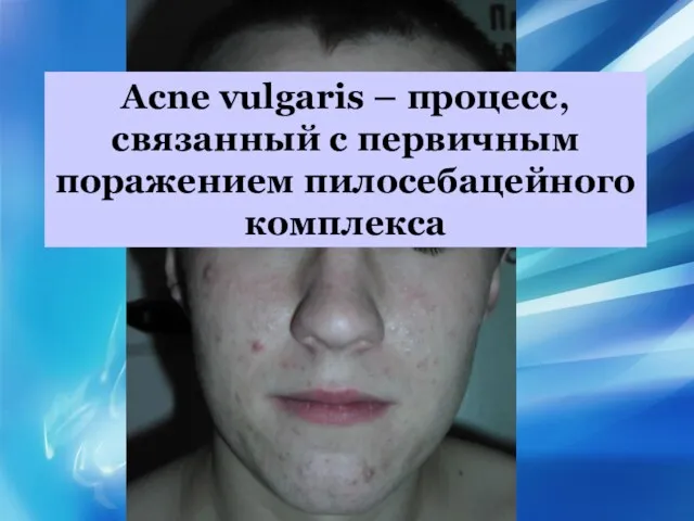 Acne vulgaris – процесс, связанный с первичным поражением пилосебацейного комплекса