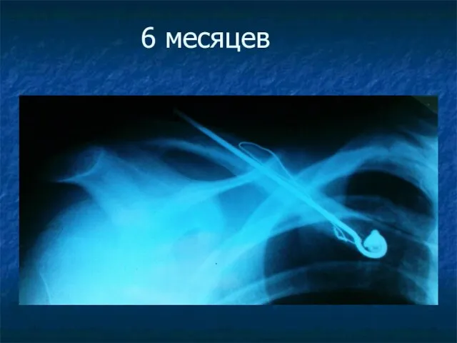 6 месяцев