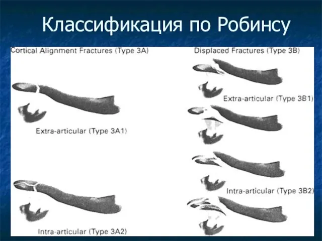 Классификация по Робинсу