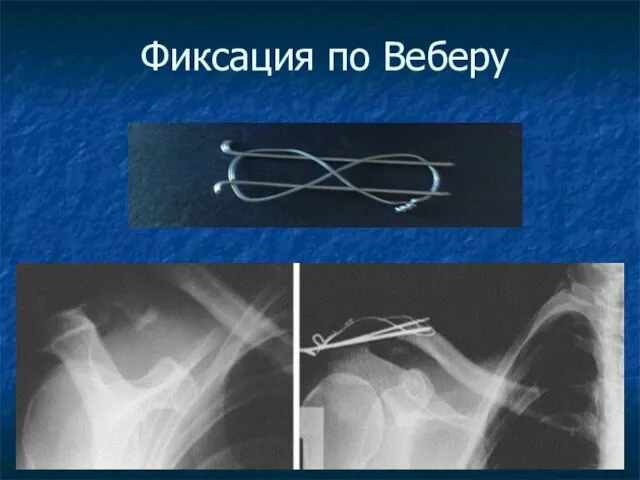 Фиксация по Веберу