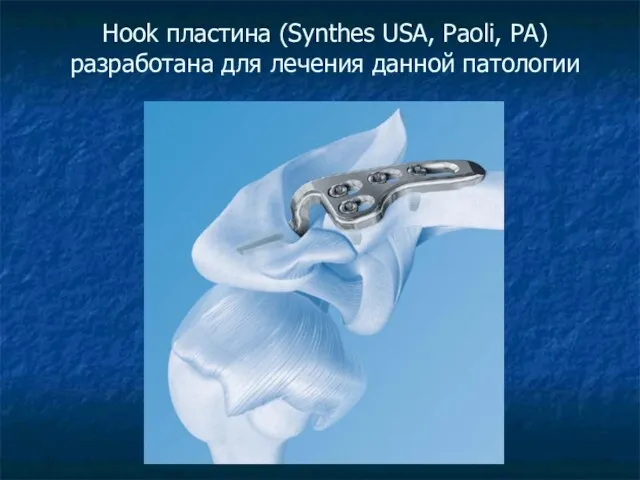 Hook пластина (Synthes USA, Paoli, PA) разработана для лечения данной патологии