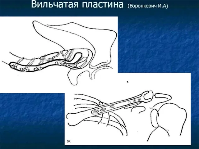 Вильчатая пластина (Воронкевич И.А)