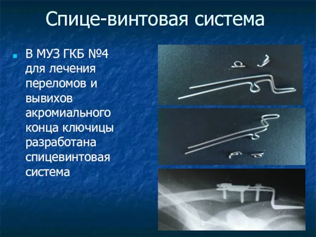 Спице-винтовая система В МУЗ ГКБ №4 для лечения переломов и