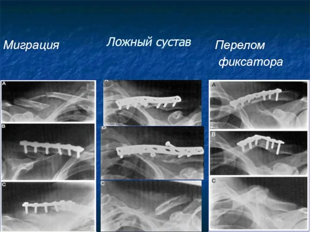 Ложный сустав Миграция Перелом фиксатора