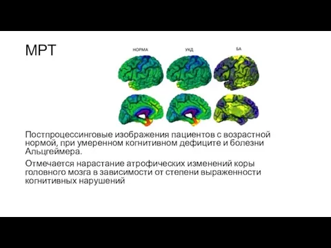 МРТ Постпроцессинговые изображения пациентов с возрастной нормой, при умеренном когнитивном
