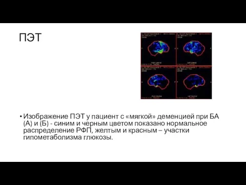 ПЭТ Изображение ПЭТ у пациент с «мягкой» деменцией при БА