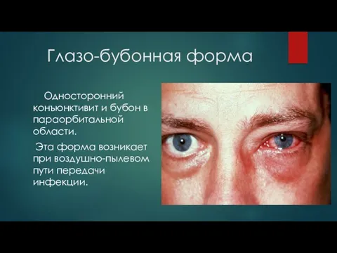 Глазо-бубонная форма Односторонний конъюнктивит и бубон в параорбитальной области. Эта